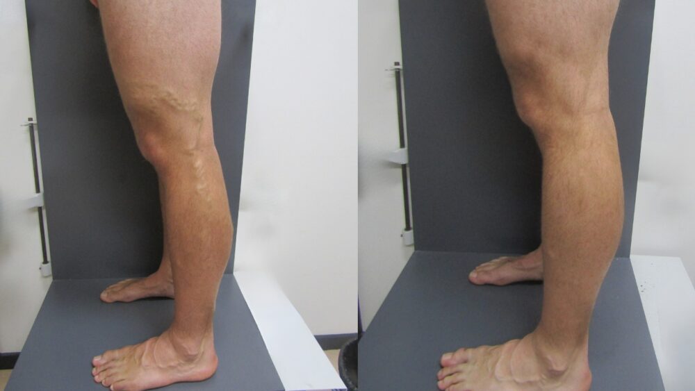 Athlete’s Recovery Through Advanced Varicose Vein Treatments - Best Vein Varicose Clinic in Victoria Melbourne