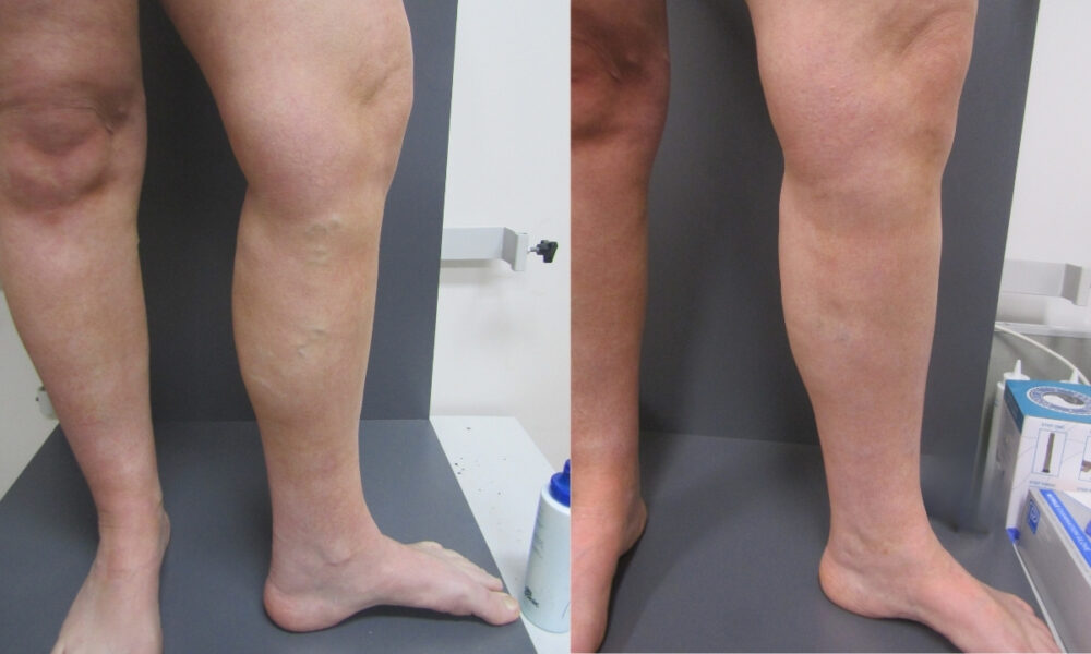Relief From Varicose Veins Through EVLA and Sclerotherapy - Best Vein Varicose Clinic in Victoria Melbourne