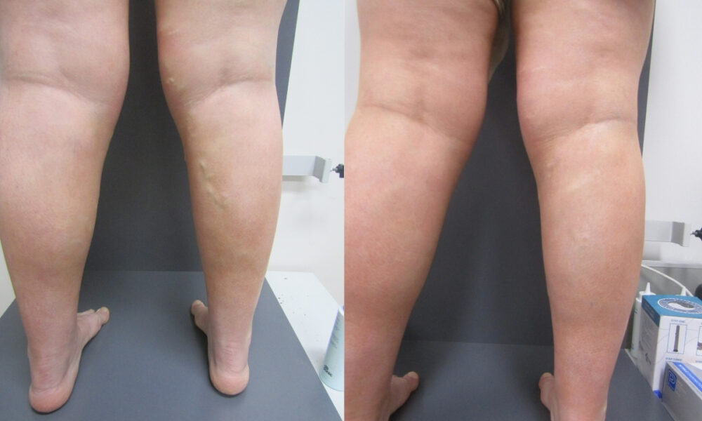 Comprehensive Varicose Vein Treatment With EVLA, Sclerotherapy & Phlebectomy - Best Vein Varicose Clinic in Victoria Melbourne
