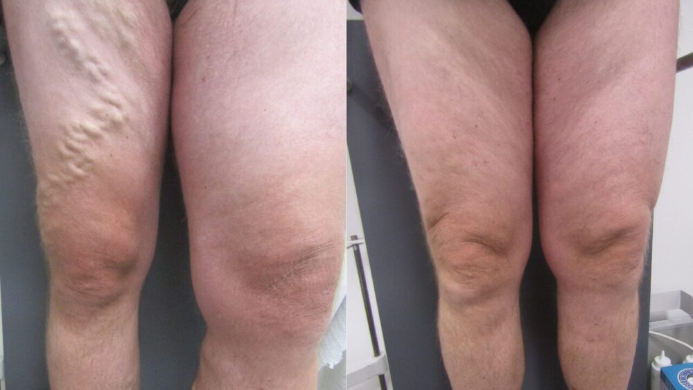 Varicose Vein ELVA Treatment in Melbourne