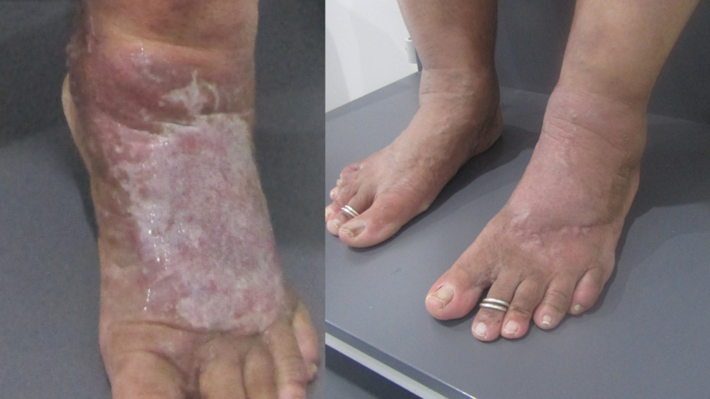 30-Year Varicose Vein Journey: From Ulcer to Pain-Free Walking