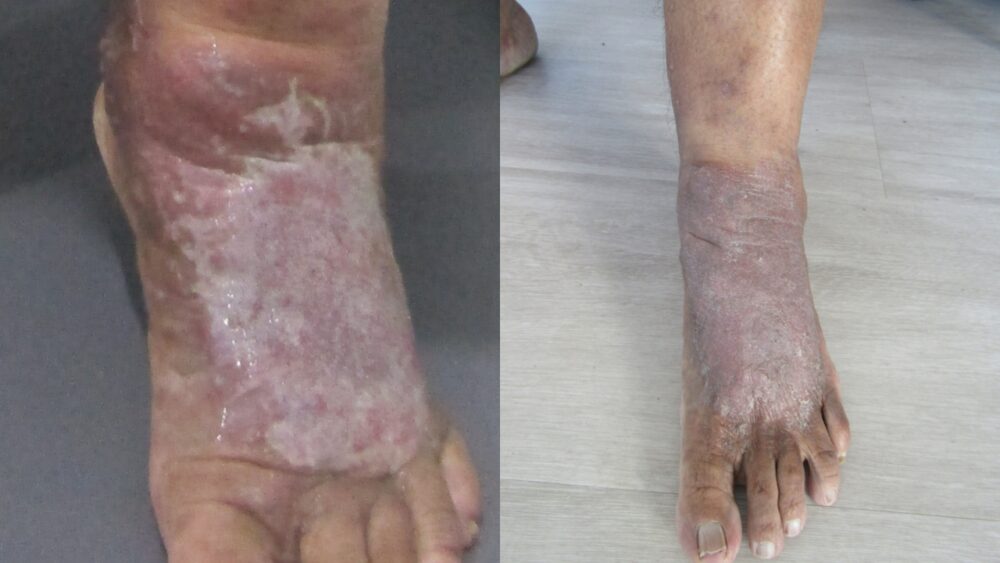 30-Year Varicose Vein Journey: From Ulcer to Pain-Free Walking - Best Vein Varicose Clinic in Victoria Melbourne