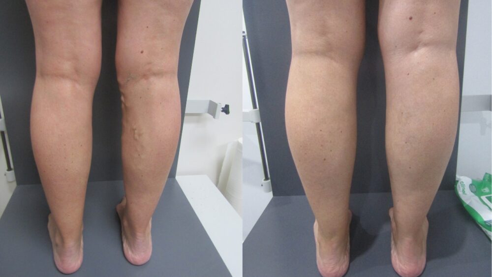 Pregnancy-Related Varicose Veins: 4-Year Success Story with EVLA Treatment - Best Vein Varicose Clinic in Victoria Melbourne