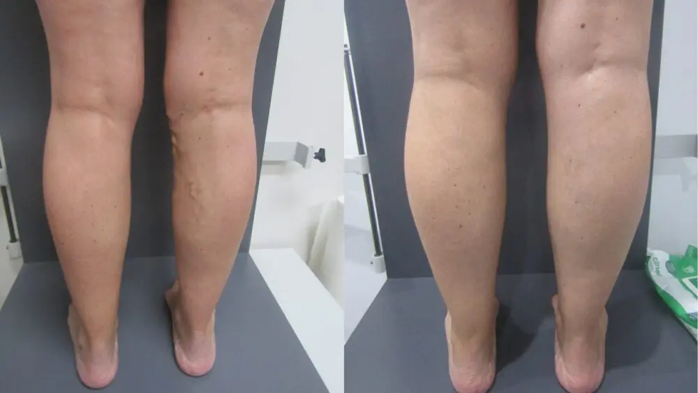 glutathione varicose veins Vein Treatment | Vanishing Northwest Why does hyperpigmentation occur after