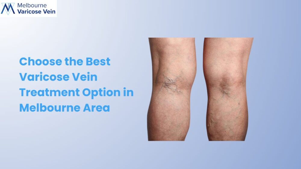 Varicose Vein Treatment Options in Melbourne - Best Vein Varicose Clinic in Victoria Melbourne