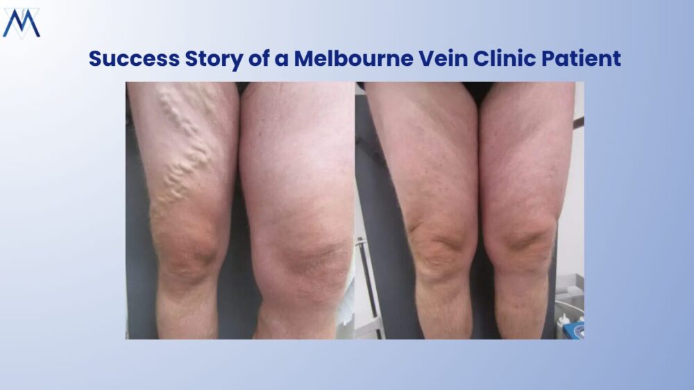 Varicose Vein Treatment - Melbourne Varicose Vein Clinic