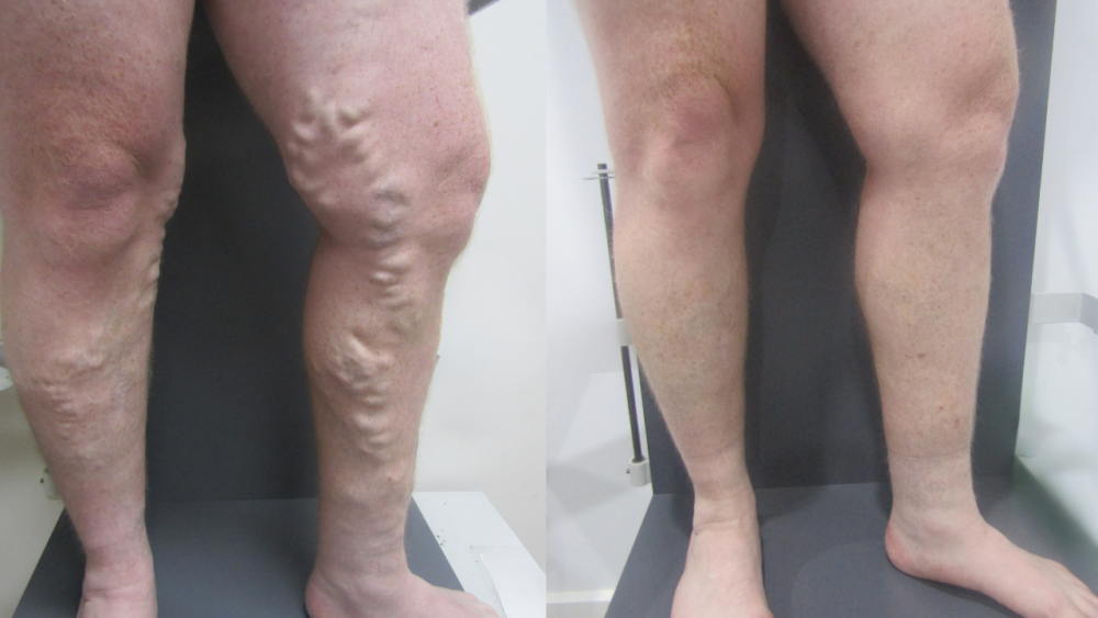 From Teenage Struggle to Pain-Free Legs: A Tradesman’s Varicose Vein Journey - Best Vein Varicose Clinic in Victoria Melbourne