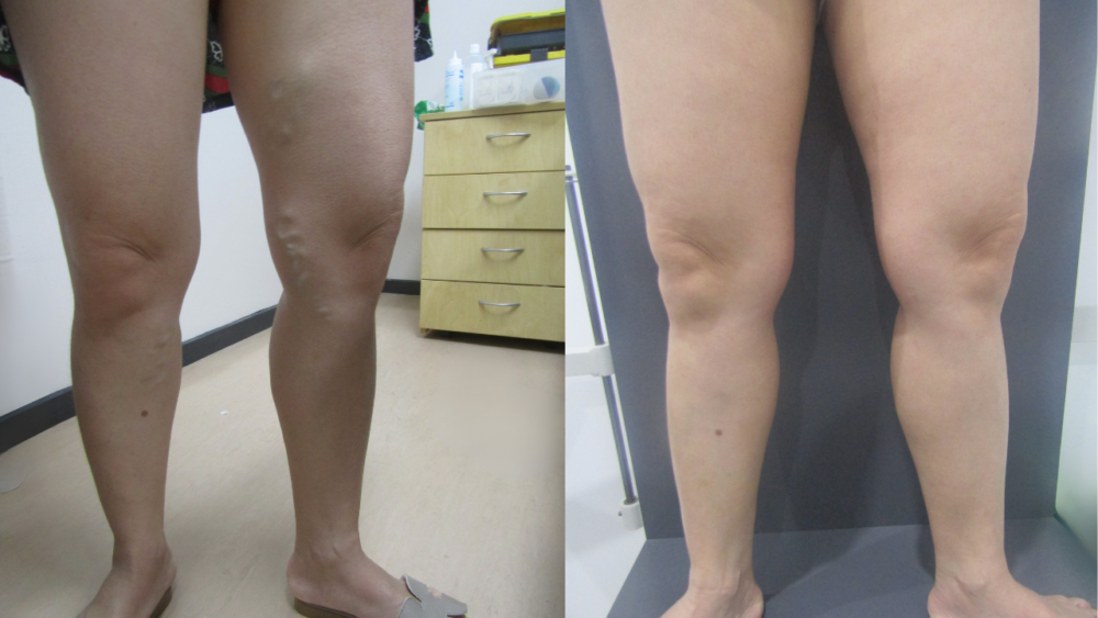 From Bulging Varicose Veins to Pain-Free Legs: A Hairdresser’s Journey - Best Vein Varicose Clinic in Victoria Melbourne