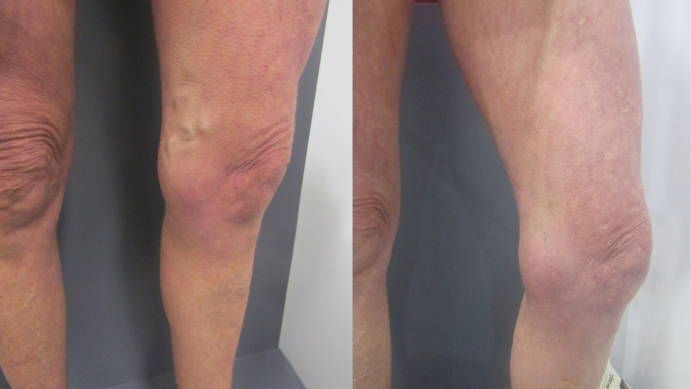 30 Years of Varicose Veins Resolved - Best Vein Varicose Clinic in Victoria Melbourne